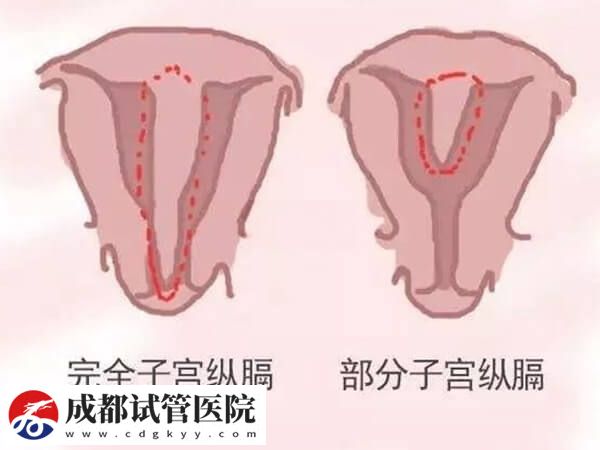 纵隔子宫的危害除了反复流产还有什么？(图1)
